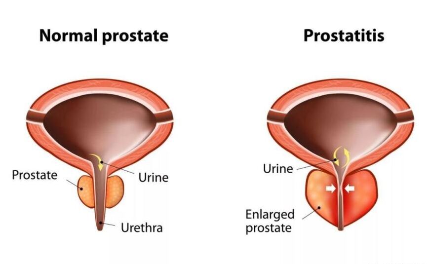 Normální prostata a zanícené