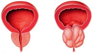 Zdravá a zanícená prostata prostatitidou
